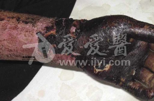 碳疽怎么念(  炭疽对人有威胁吗)