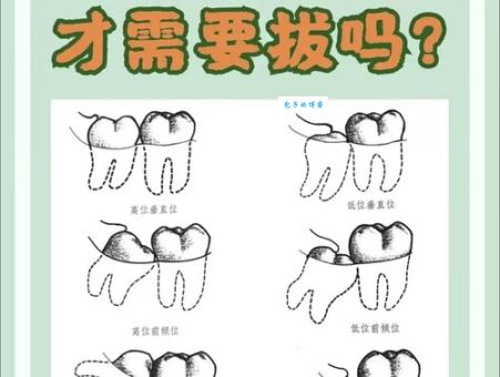 河南拔智齿是什么意思 疼不疼多久能恢复