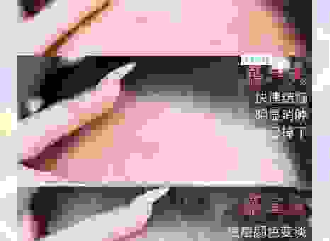 怎样去除青春痘印最有效？快速告别痘印的秘诀！