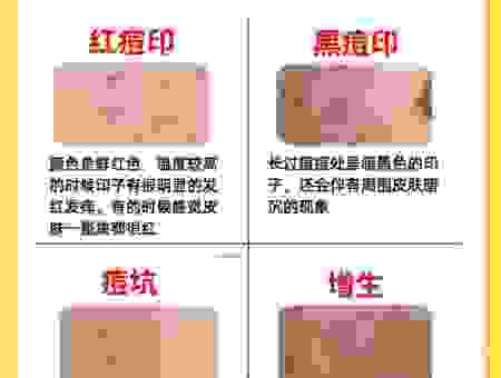 怎样去除青春痘印最有效？快速告别痘印的秘诀！